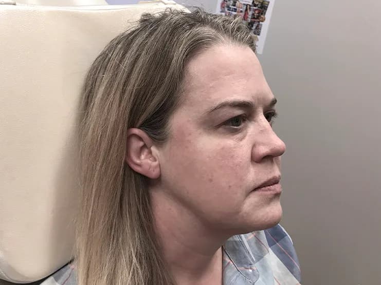 Ultherapy, cheeks and jawline, after