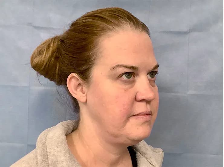 Ultherapy, cheeks and jawline, before