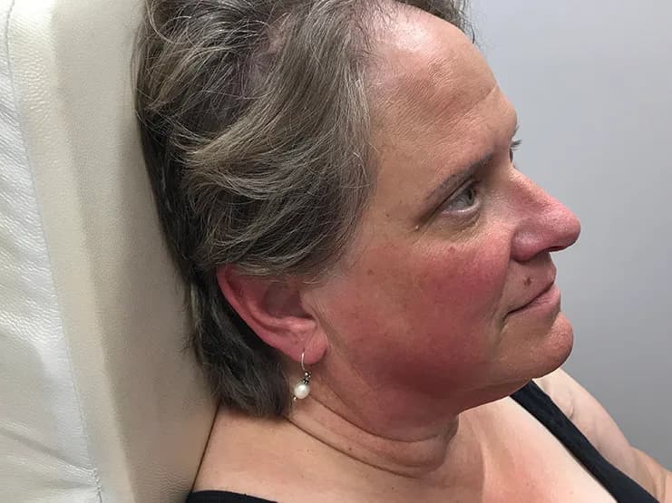 Ultherapy, jawline and under-chin, after