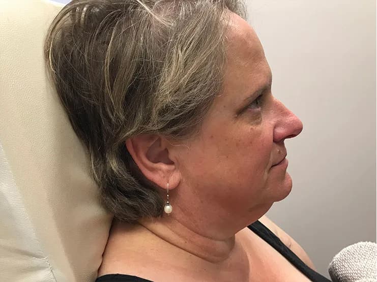 Ultherapy, jawline and under-chin, before