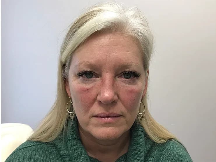 Ultherapy, full face, after