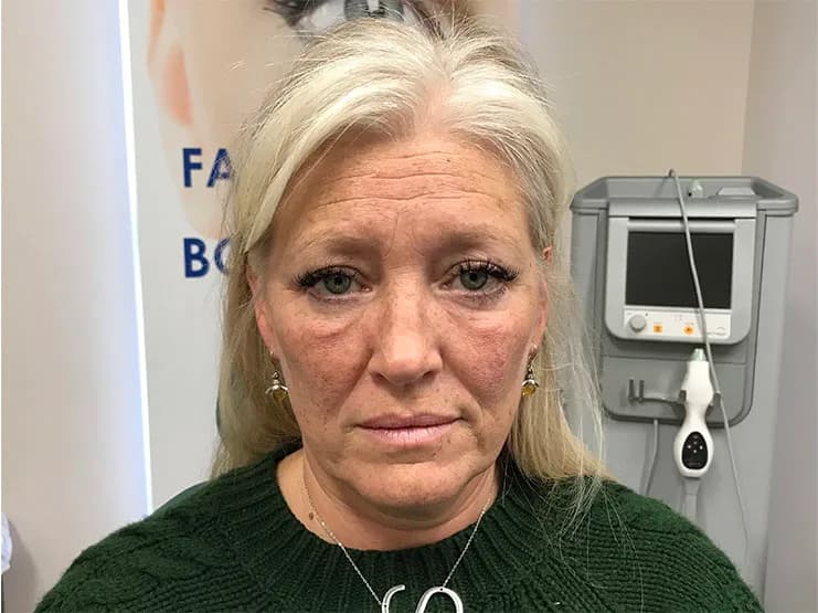 Ultherapy, full face, before
