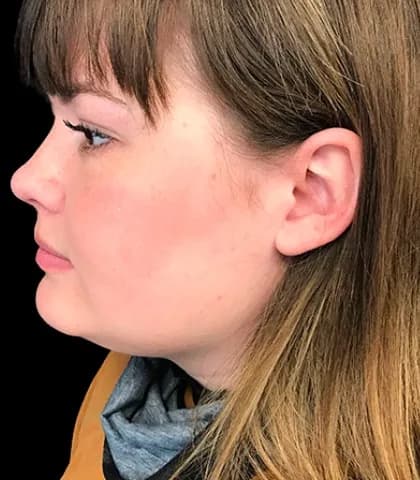 VASER liposuction, chin and jawline, after
