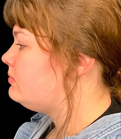 VASER liposuction, chin and jawline, before
