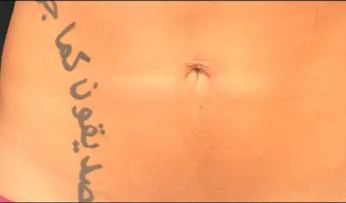 VASER liposuction, abdomen, after