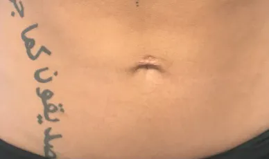 VASER liposuction, abdomen, before