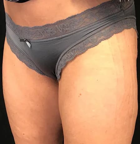 VASER liposuction, thighs, after
