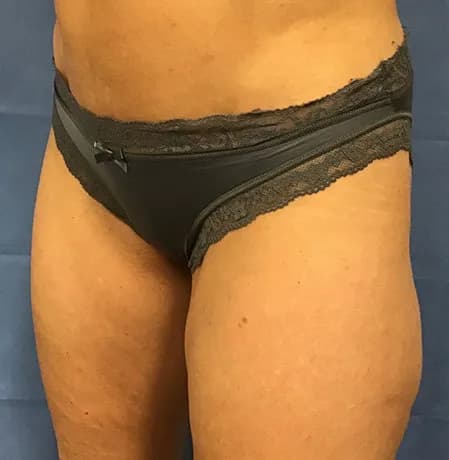 VASER liposuction, thighs, before