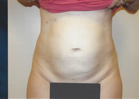 VASER liposuction, abdomen, after