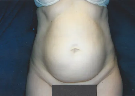 VASER liposuction, abdomen, before