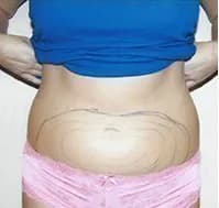VASER liposuction, abdomen, before
