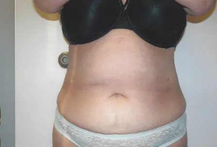 VASER liposuction, abdomen, after