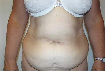 VASER liposuction, abdomen, before