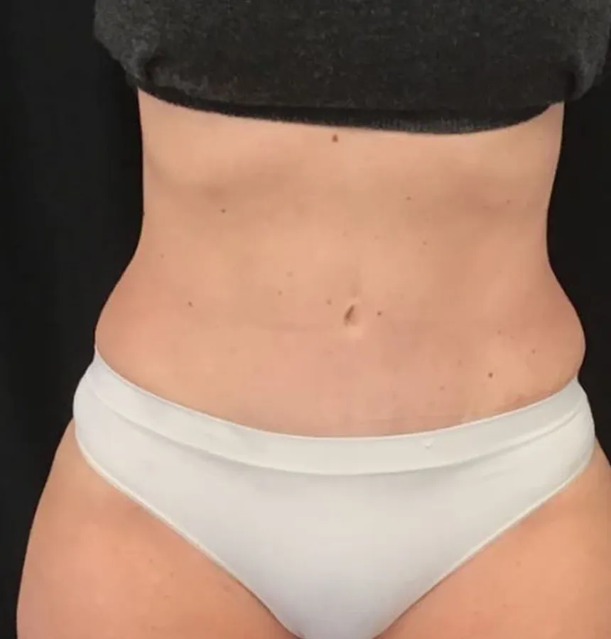 VASER liposuction, abdomen and waist, oblique view, after