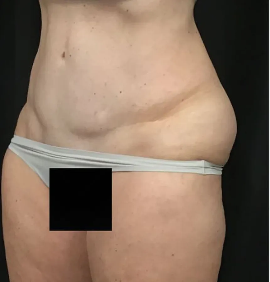 VASER liposuction, abdomen and waist, oblique view, before