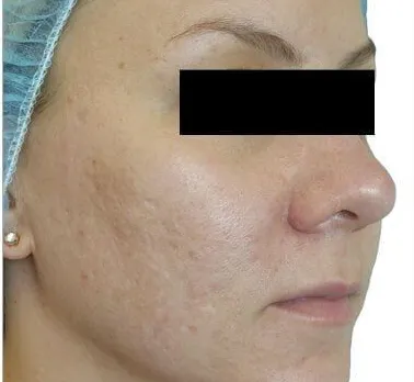 Venus Viva for acne scars, after two treatments, after