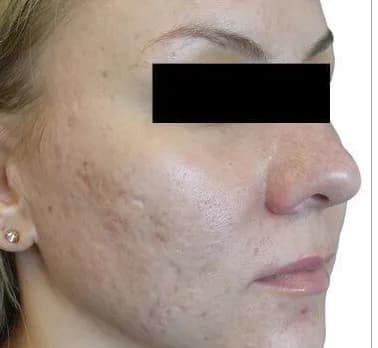 Venus Viva for acne scars, after two treatments, before