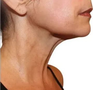 Venus Viva, neck and jawline, after six treatments, after