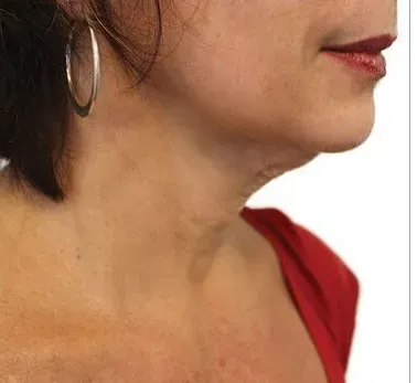 Venus Viva, neck and jawline, after six treatments, before