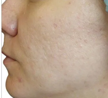 Venus Viva for acne and redness, after three treatments, after