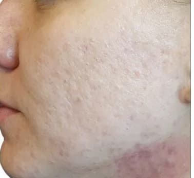 Venus Viva for acne and redness, after three treatments, before