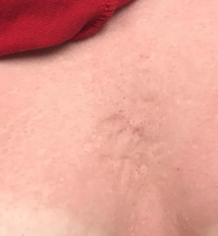 Venus Viva, chest, after