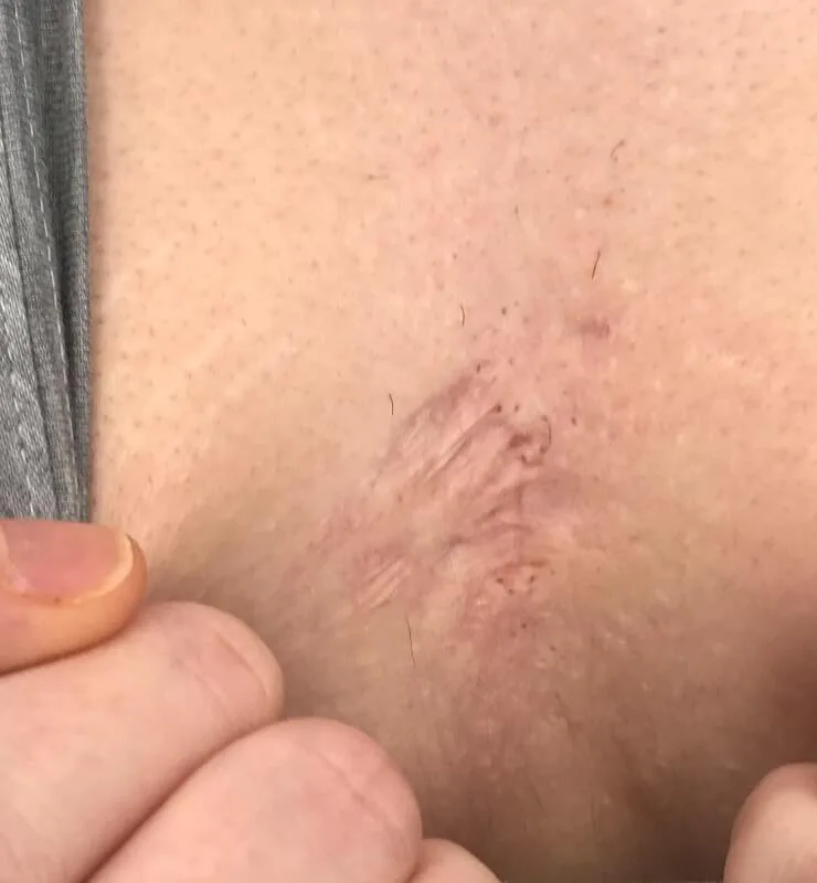 Venus Viva, chest, before