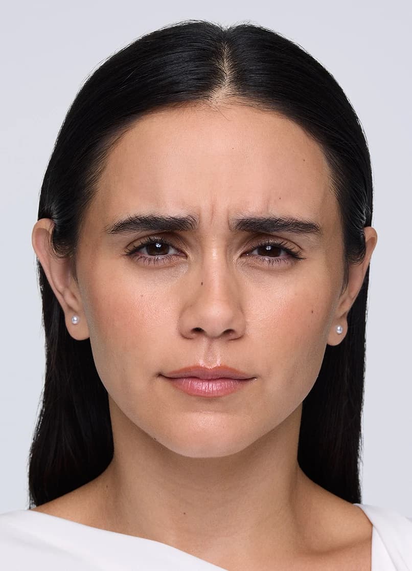 Xeomin, frown lines, 14 days, before