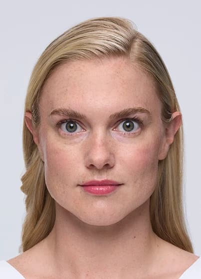 Xeomin, forehead lines, 14 days, after