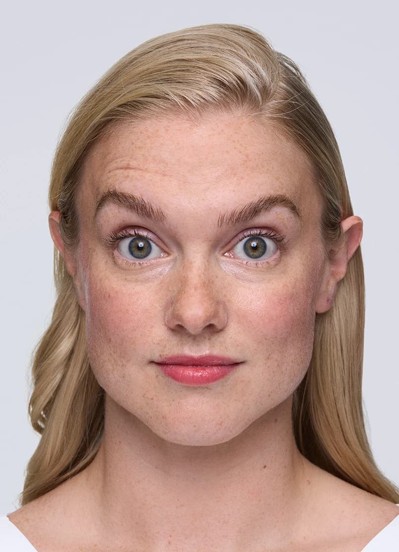 Xeomin, forehead lines, 14 days, before