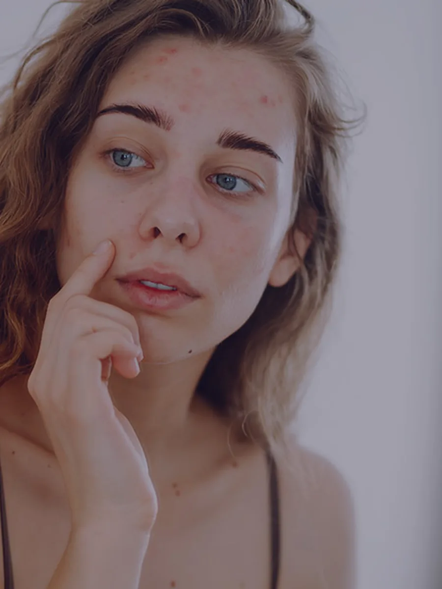 AviClear Acne Treatment at The Dermatology, Laser & Vein Center in Cincinnati