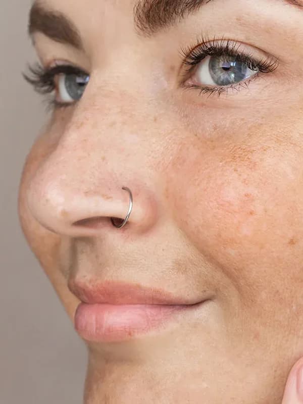 Cosmelan at The Dermatology, Laser & Vein Center in Cincinnati