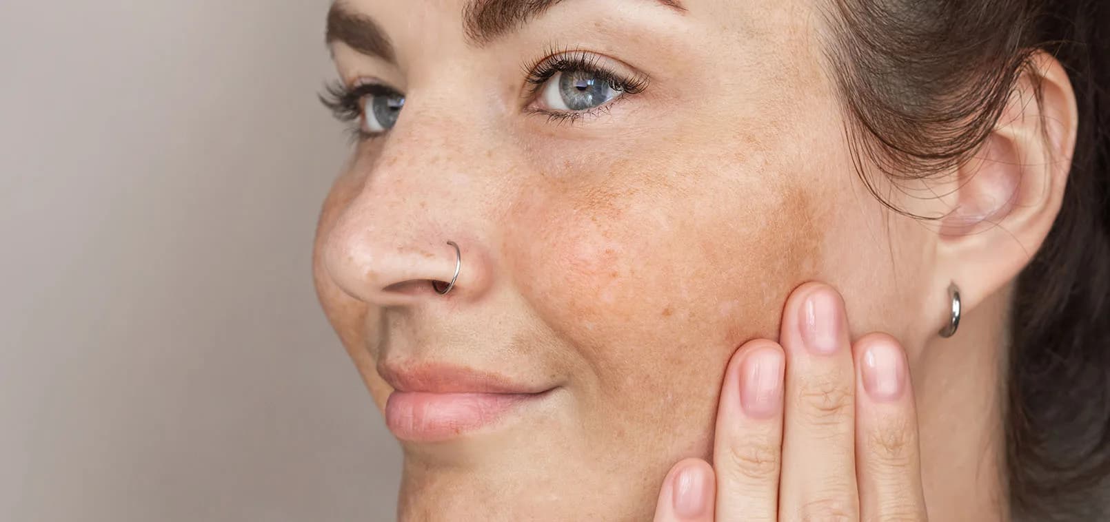 Close view of a woman's cheek with freckles and sun-related pigmentation