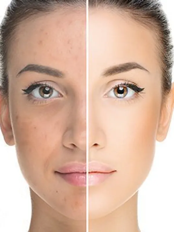 Effective Methods of Acne Scar Removal at The Dermatology, Laser & Vein Center in Cincinnati