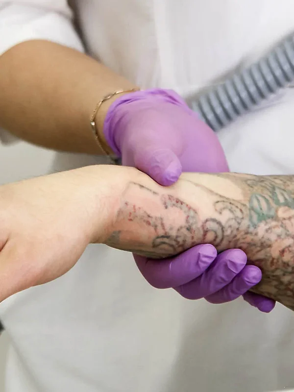 Laser Tattoo Removal at The Dermatology, Laser & Vein Center in Cincinnati