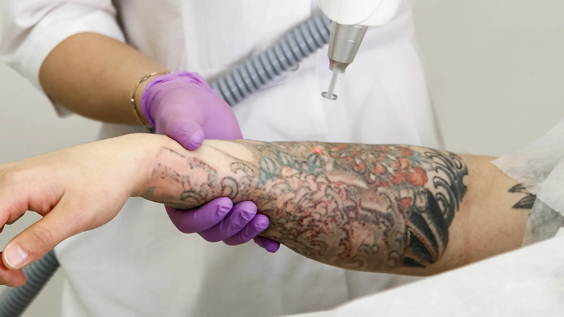 Practitioner removing a colorful forearm tattoo with a laser handpiece