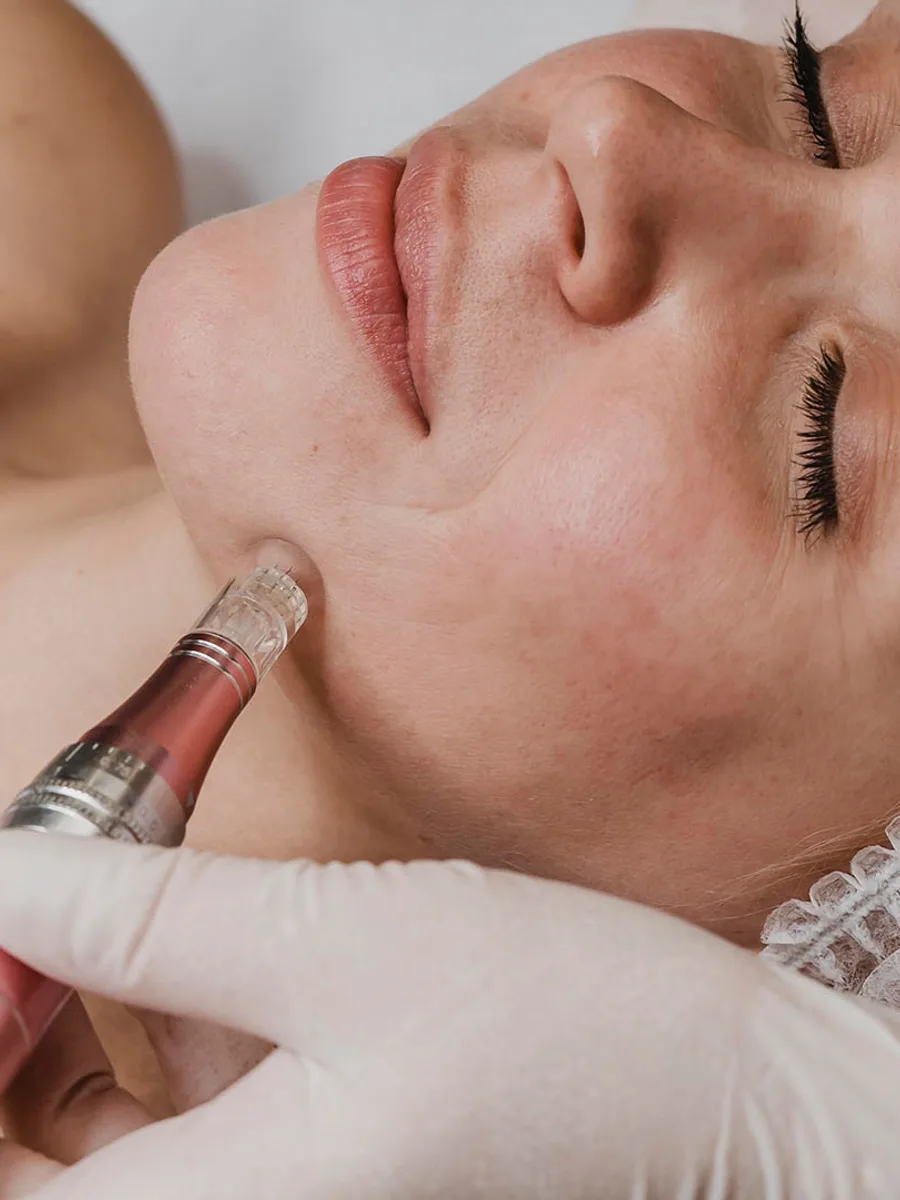 Microneedling at The Dermatology, Laser & Vein Center in Cincinnati