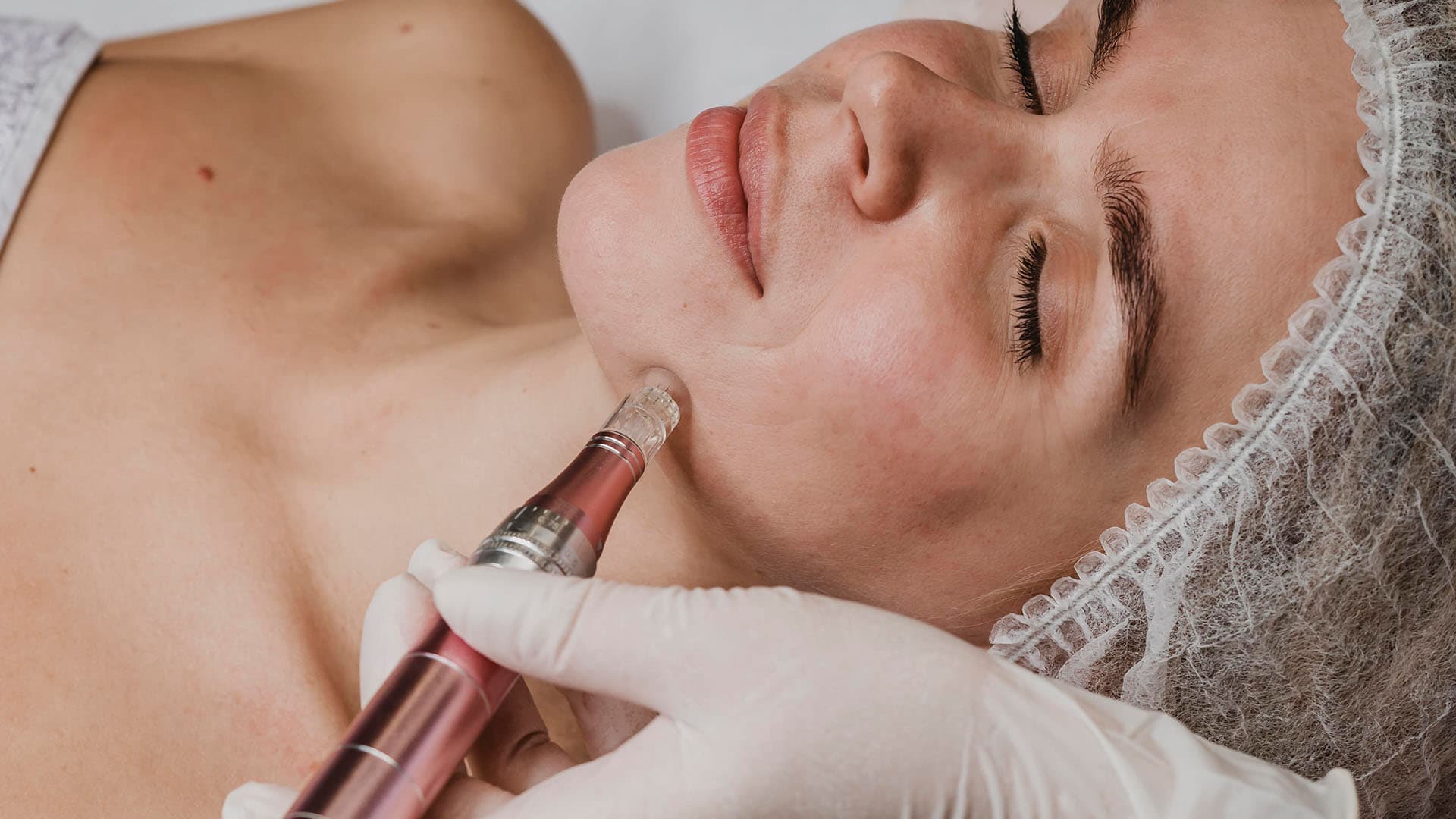 Microneedling pen gliding along a woman's jawline during a collagen induction treatment