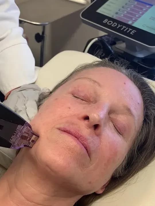 Morpheus8 at The Dermatology, Laser & Vein Center in Cincinnati