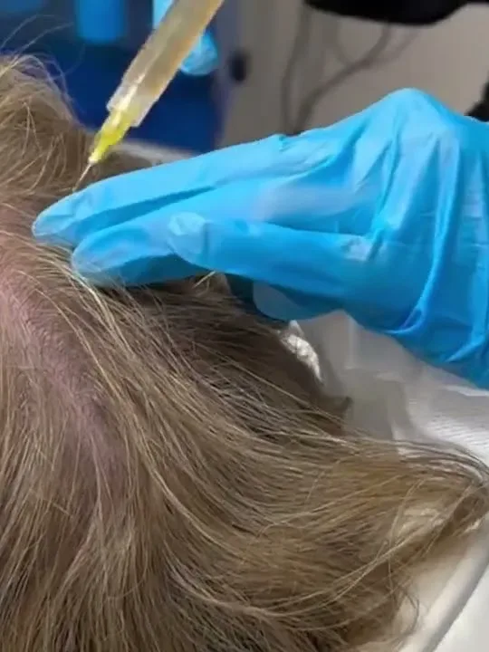 Thinning Hair & Hair Loss treatment at The Dermatology, Laser & Vein Center in Cincinnati