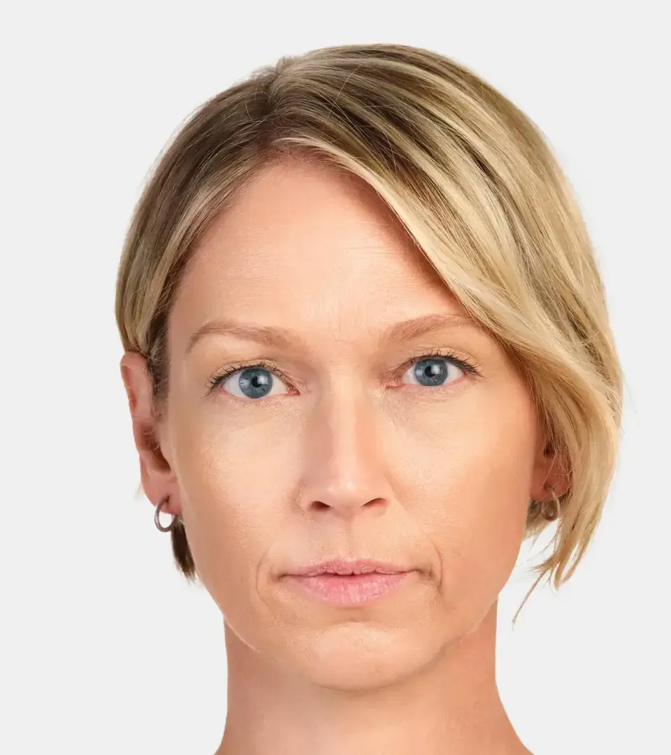 Volume Loss treatment at The Dermatology, Laser & Vein Center in Cincinnati