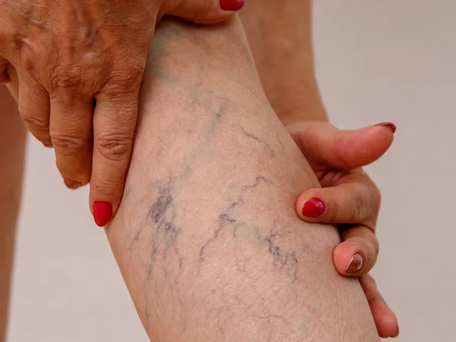 Sclerotherapy at The Dermatology, Laser & Vein Center in Cincinnati