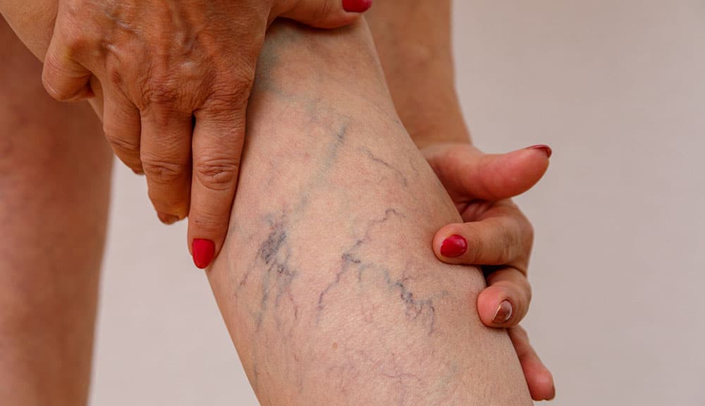 Woman holding her lower leg with visible spider veins before sclerotherapy