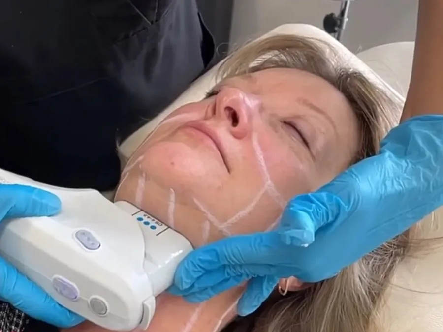 Ultherapy at The Dermatology, Laser & Vein Center in Cincinnati