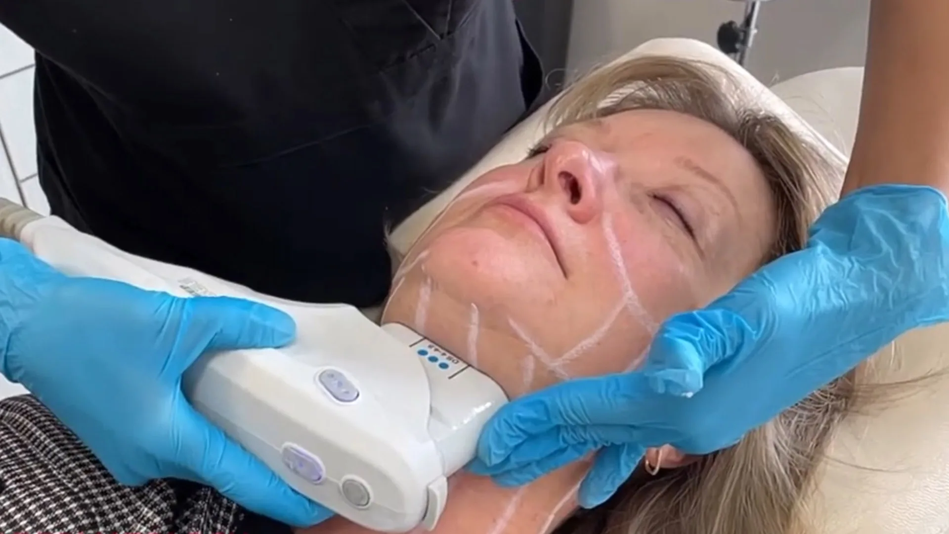 Provider guiding the Ultherapy handpiece along a patient's marked jawline and neck