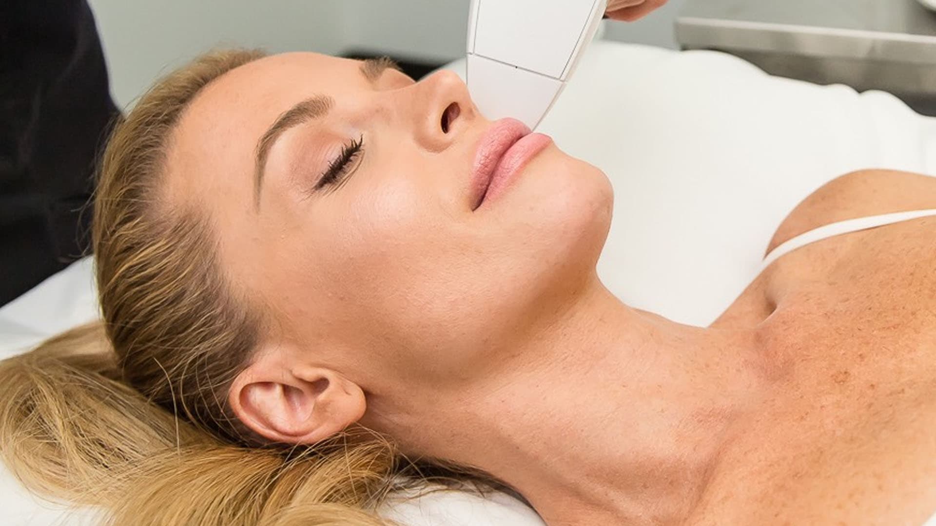 Patient receiving a Venus Viva NanoFractional Radio Frequency treatment